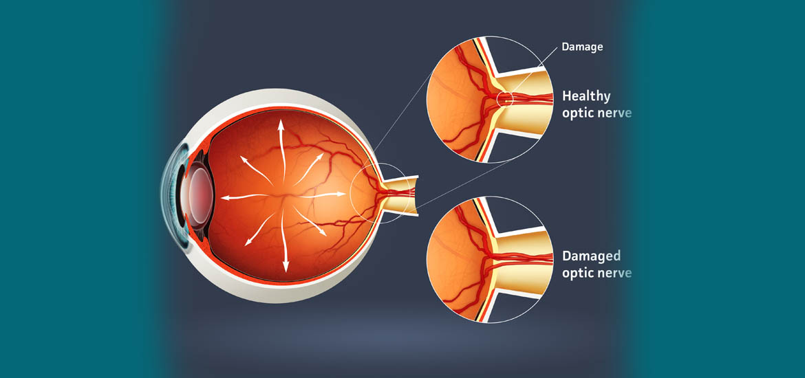 Влияние ДЭНС на уровень внутриглазного давления у пациентов с открытоугольной глаукомой